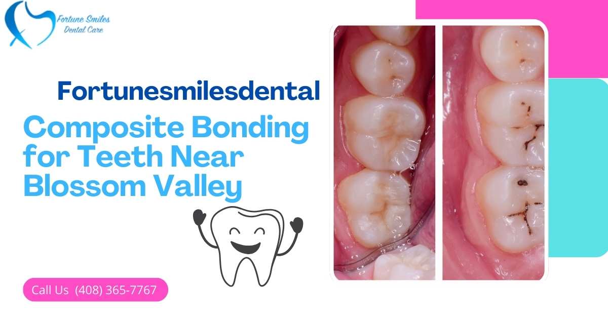 Composite Bonding for Teeth Near Blossom Valley