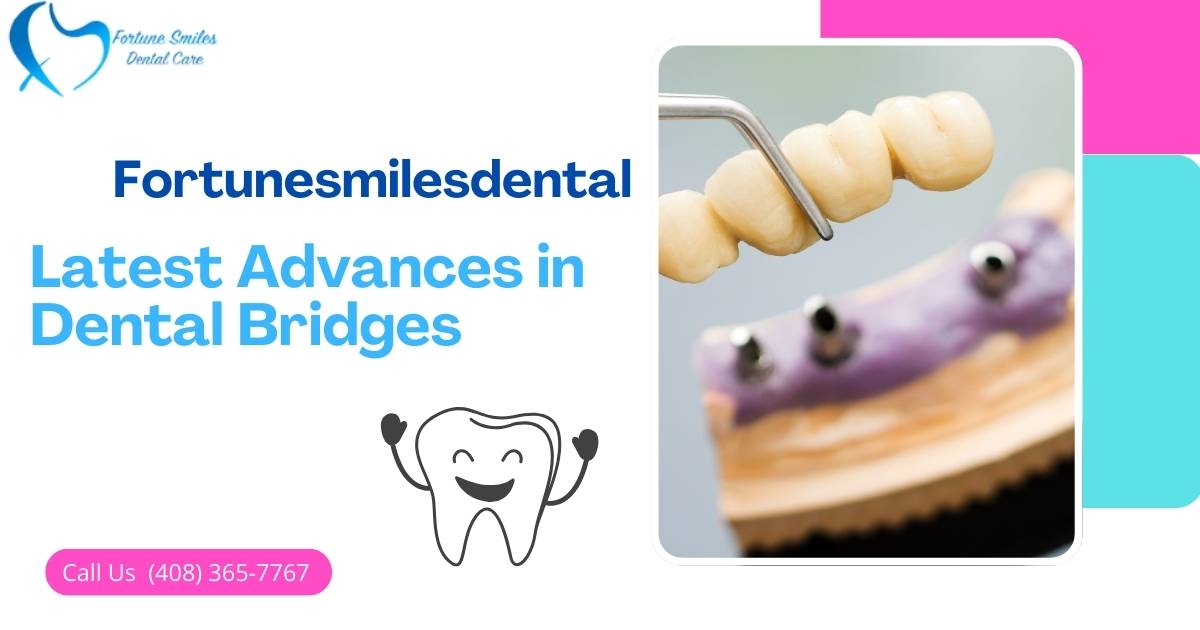 Dental Bridges