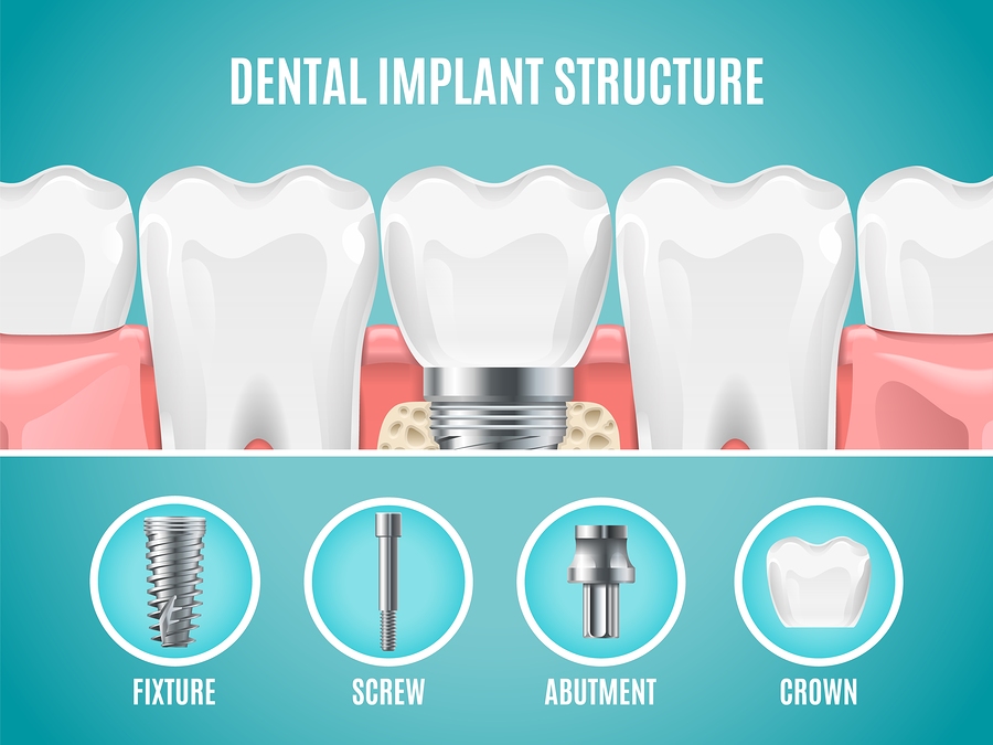 Dental Implant Structure