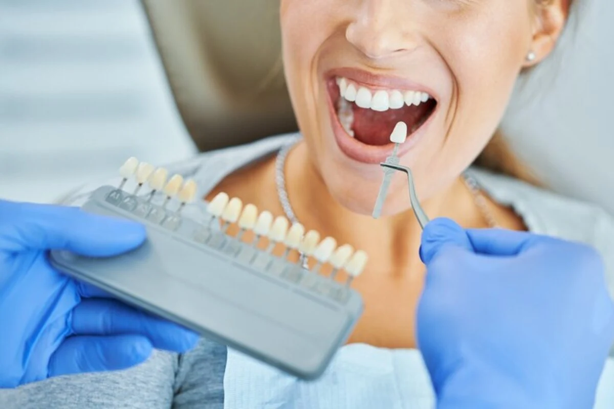 Dental veneers treatment
