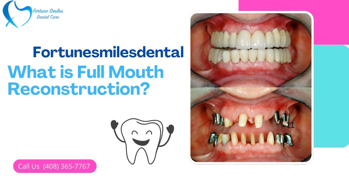 What is Full Mouth Reconstruction?