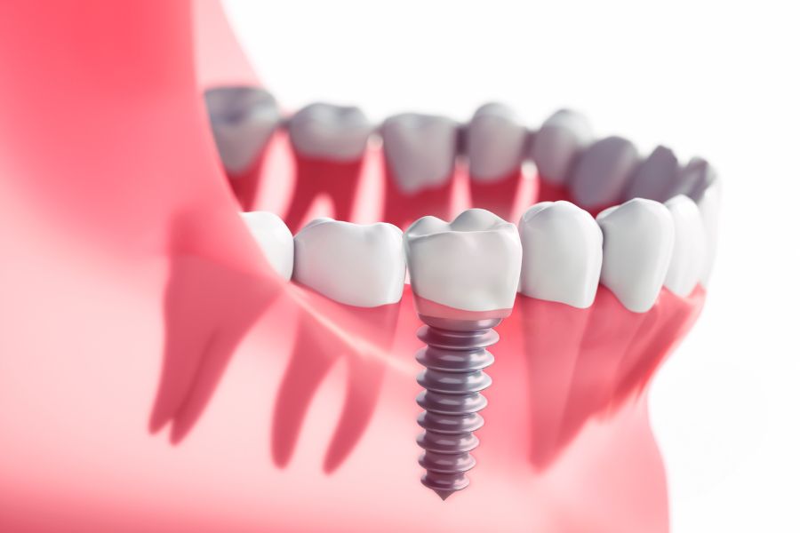Osseointegration The Healing Process