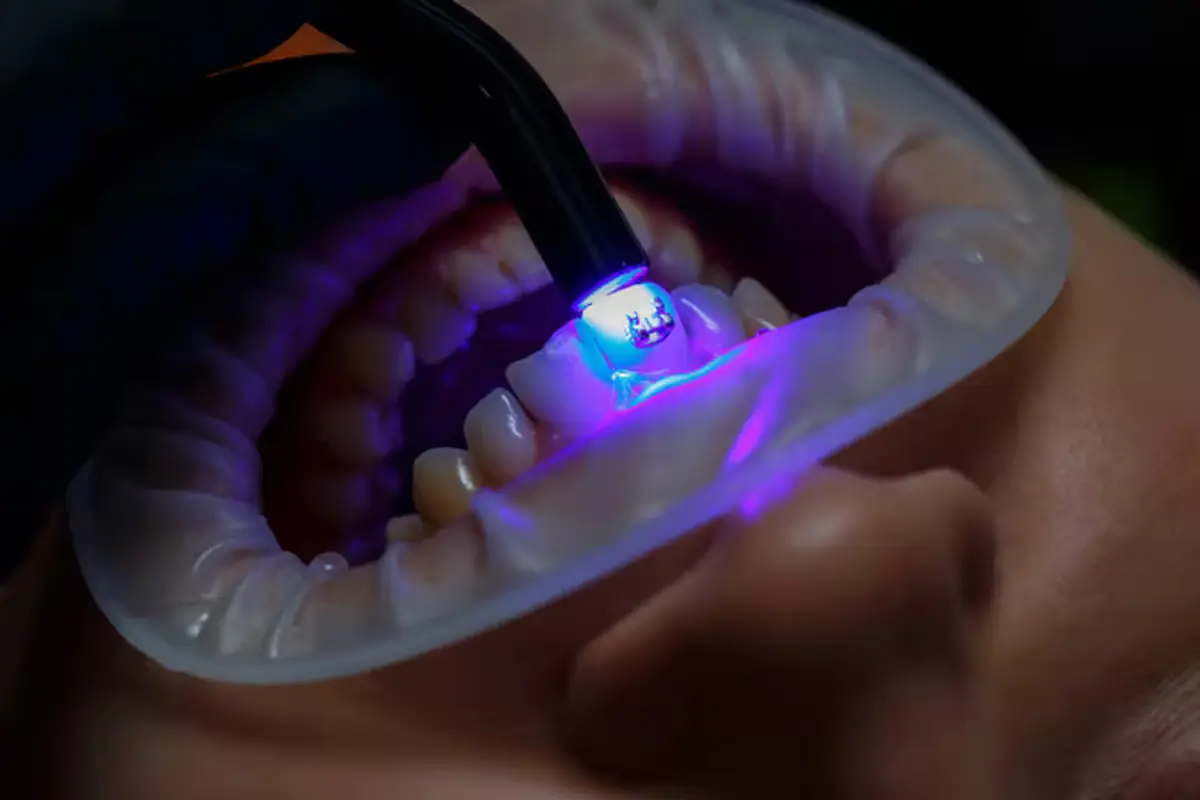 Innovative Biomimetic Applications in Dental Veneers