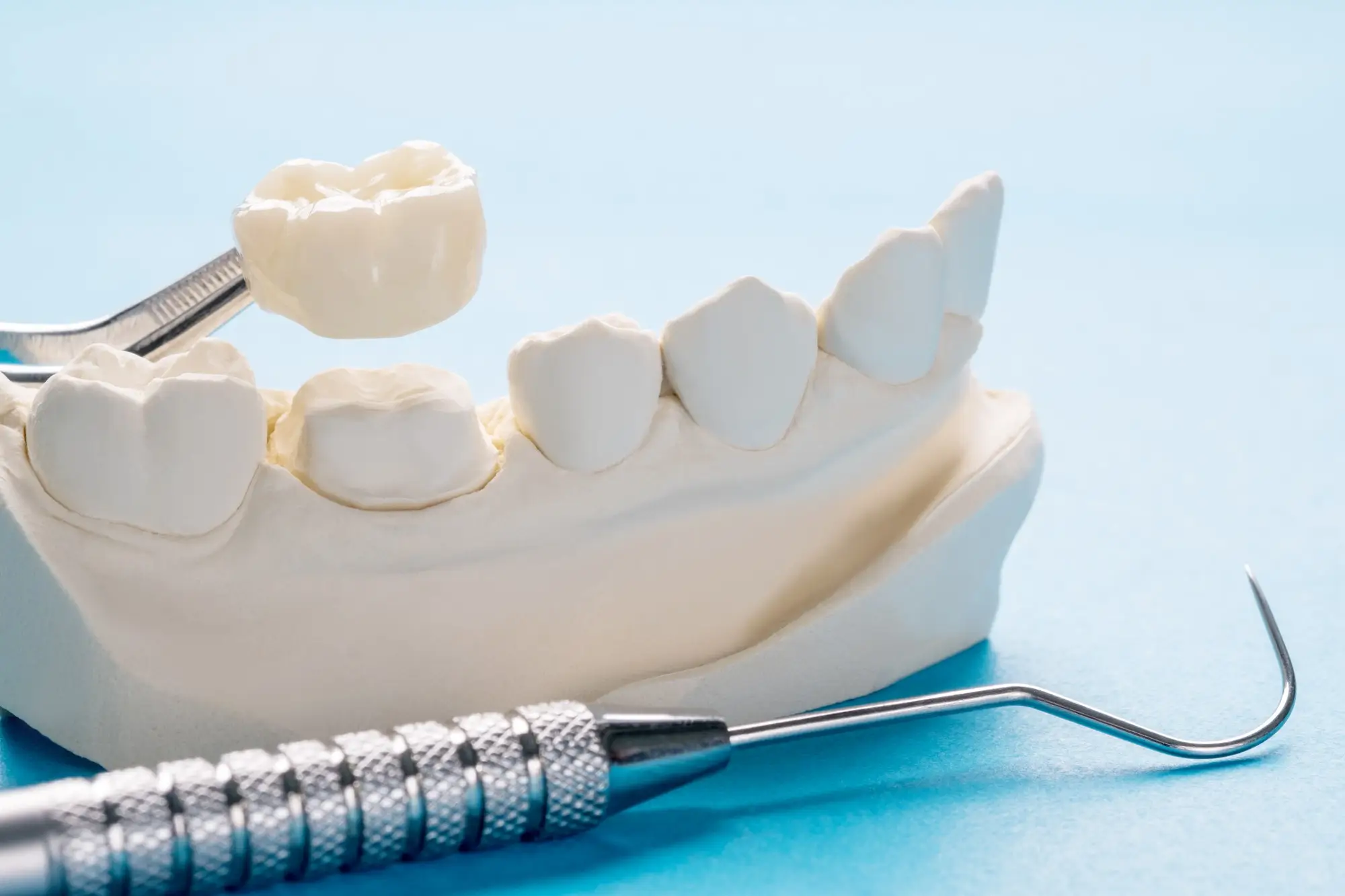 Advances in Dental Crown Techniques