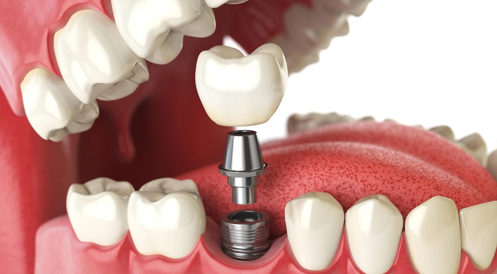 Types and Materials of Dental Implants