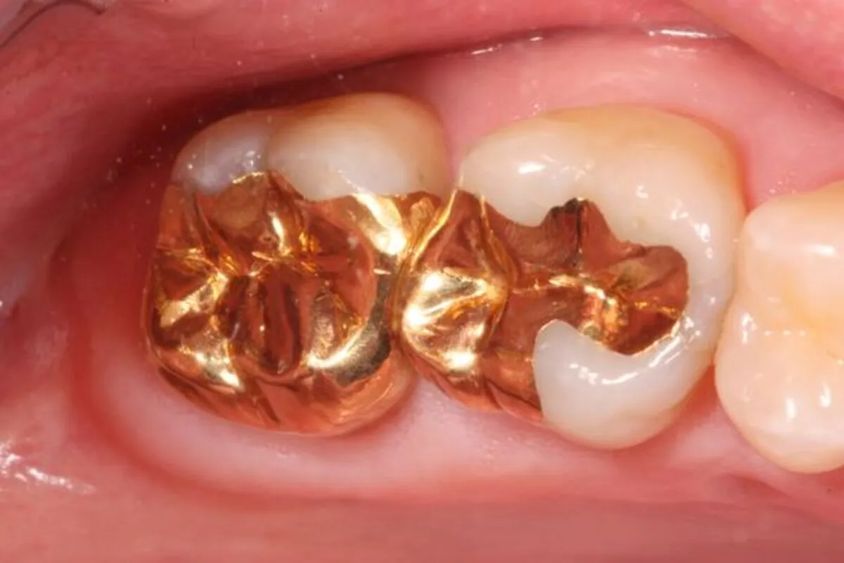 dental material