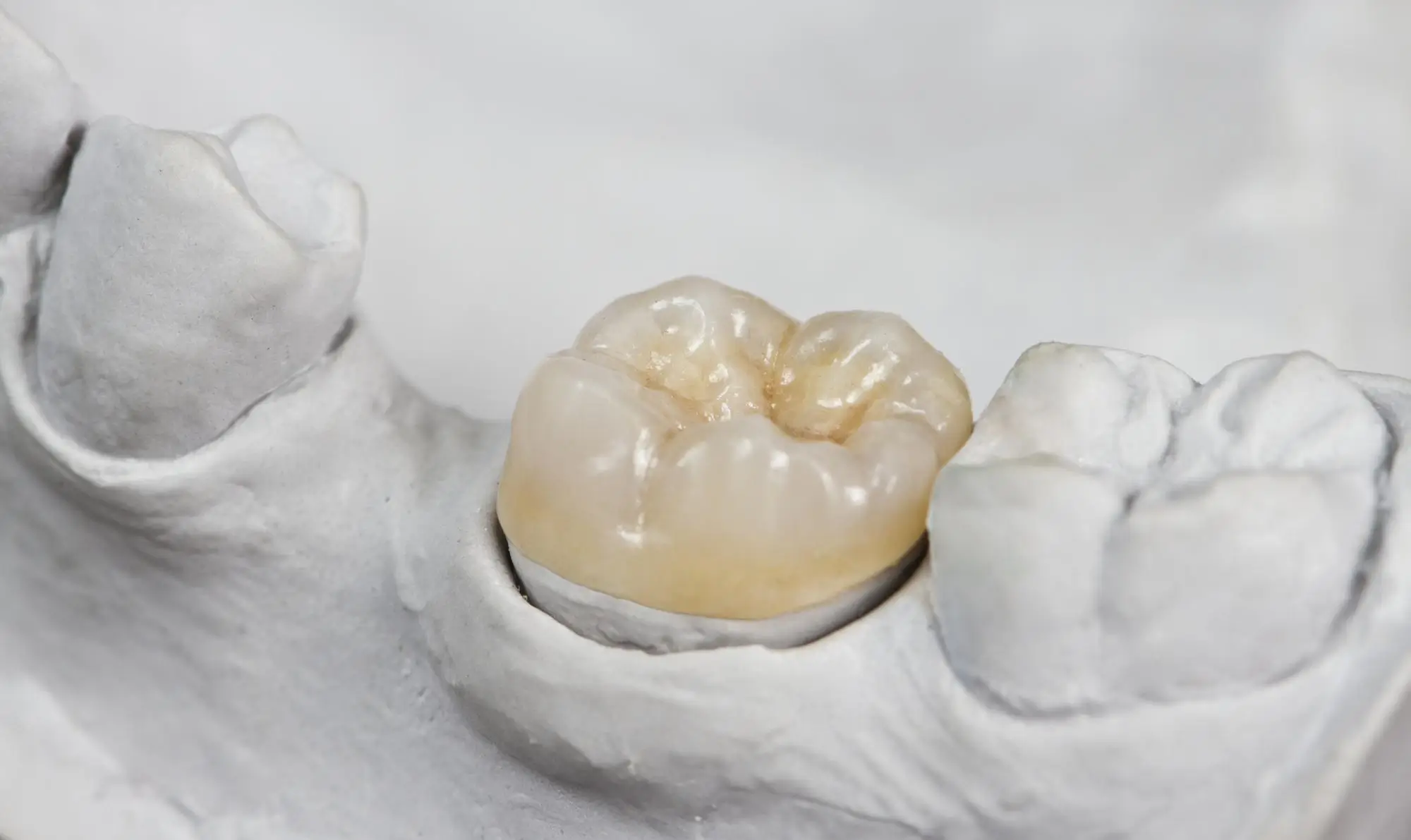 dental onlay material types