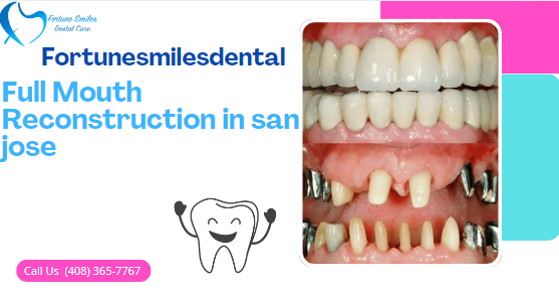 Full Mouth Reconstruction in san jose