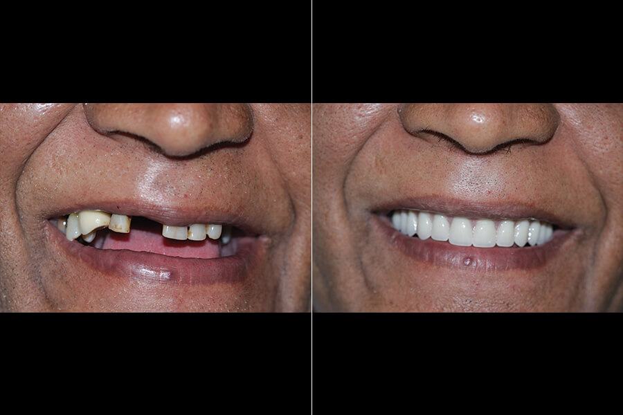 fullmouth2