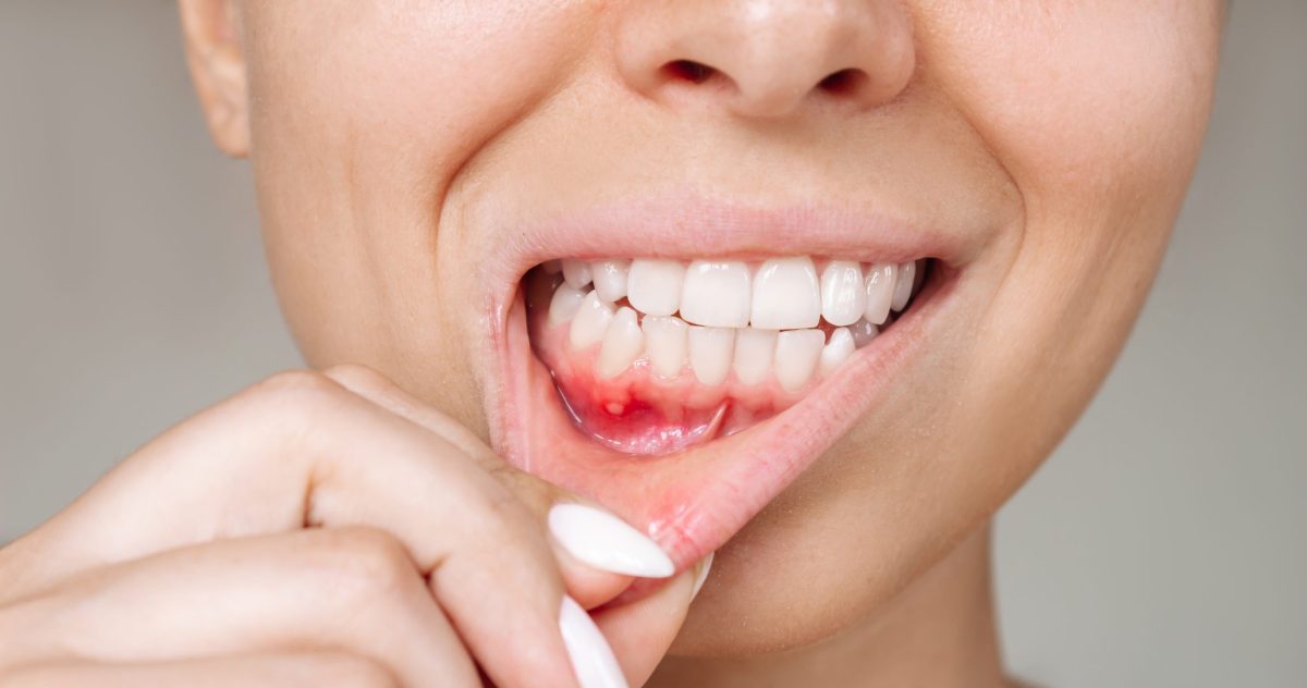 Gum Disease Prevention: Early Signs, Home Care, and When to See a Dentist