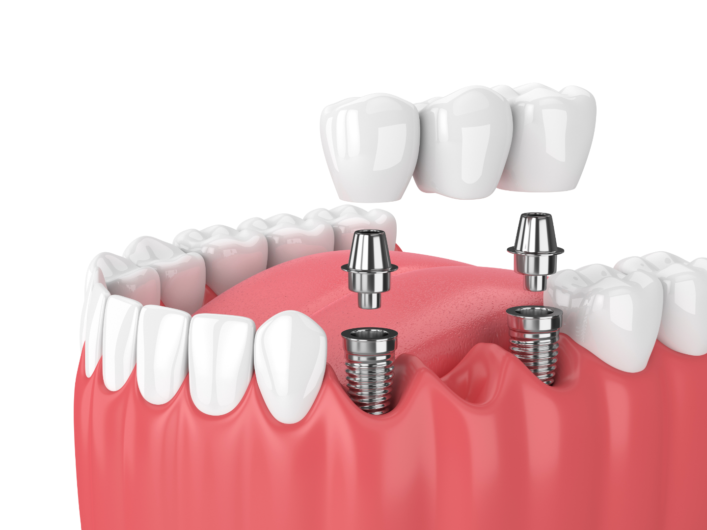 implant in oak grove