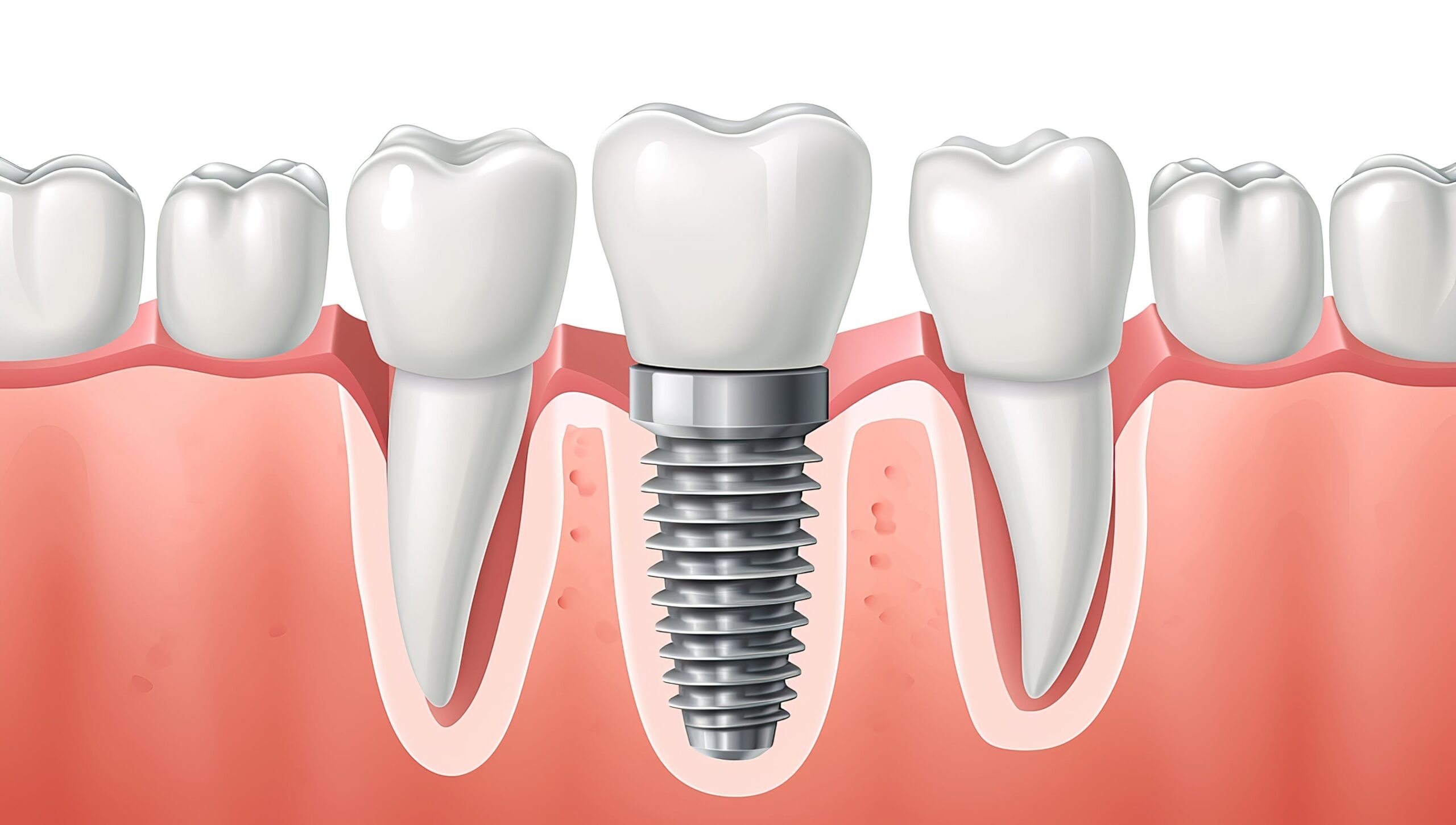 best implant in oak grove