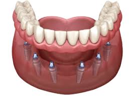 implantdentist1