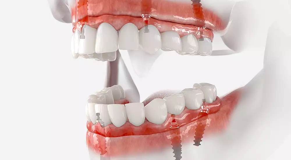 implantdentist2