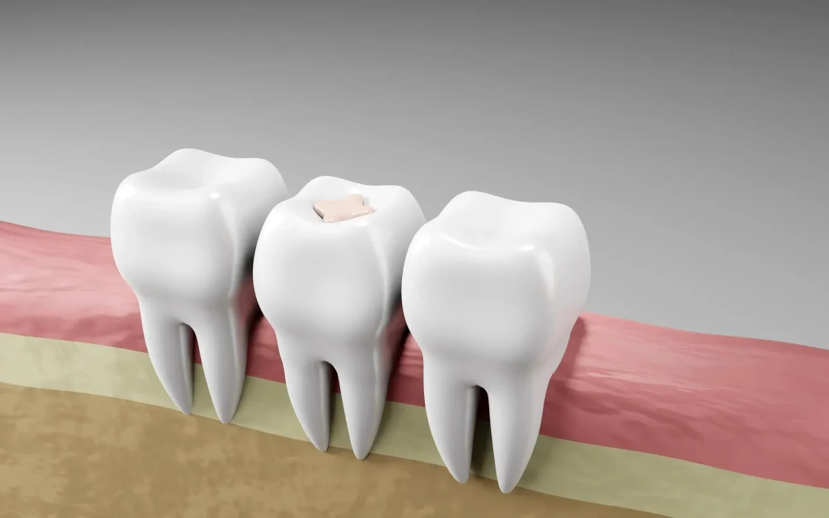 Composite inlays and onlays