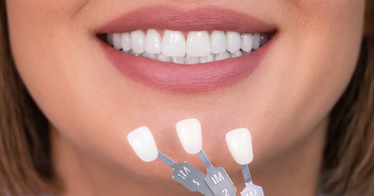 Repair vs Replace: What to Do When Veneers Chip or Stain